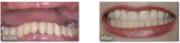 Dental Implant Before & After 2