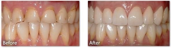 Porcelain Crowns Before & After 2