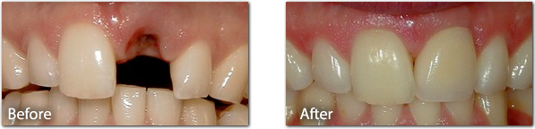 Dental Implant Before & After 1