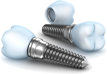 Dental Implants